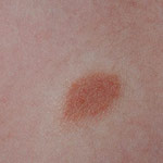Donkere vlekken op de huid mastocytoom