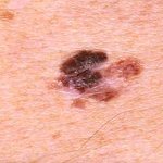 donkere vlekken op de huid melanoom