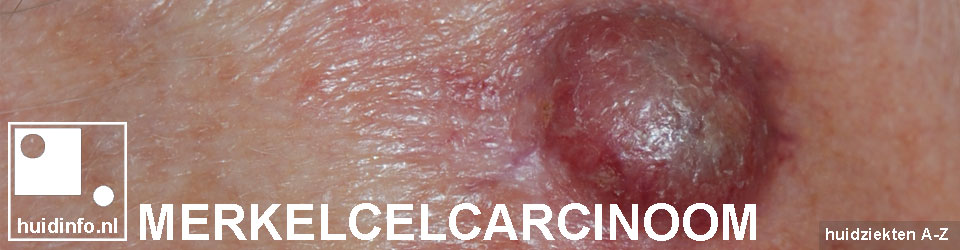 merkelcelcarcinoom