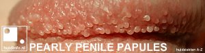pearly penile papules