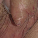 huidproblemen van de penis lichen sclerosus