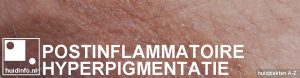 postinflammatoire hyperpigmentatie