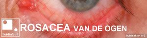 rosacea van de ogen oogrosacea