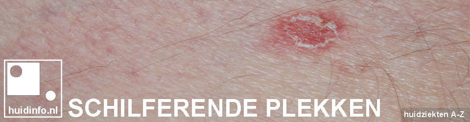 SCHILFERENDE PLEKKEN OP DE HUID - oorzaken | DERMATOLOOG