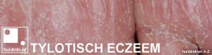 tylotisch eczeem