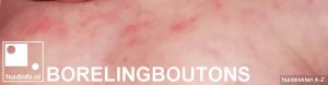 borelingboutons (erythema toxicum neonatorum)