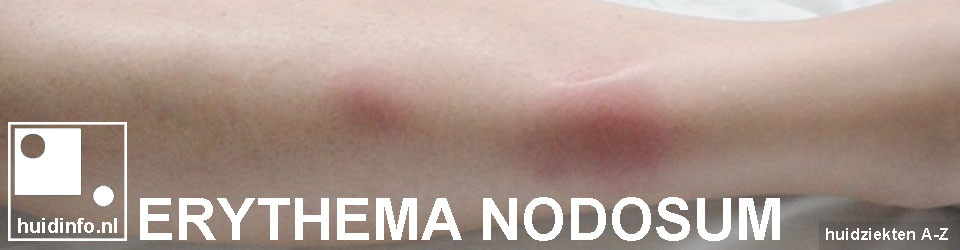 erythema nodosum