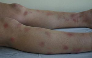 erythema nodosum