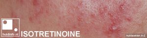 isotretinoine roaccutane