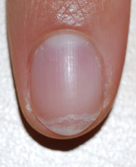 slijtende nagels gespleten nagels onychoschizia