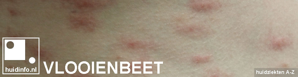 VLOOIENBETEN | uitleg van de | - dermatoloog