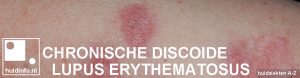 chronische discoide lupus erythematosus CDLE