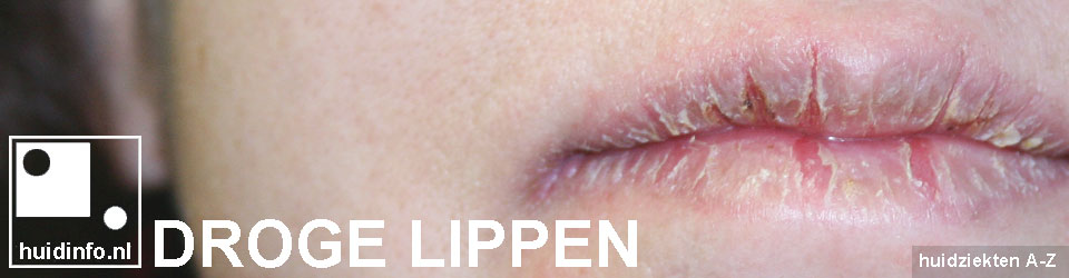 droge lippen