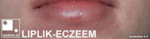 liplik eczeem lip lick dermatitis