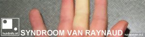 syndroom van raynaud