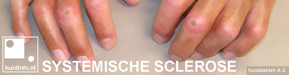 systemische sclerose