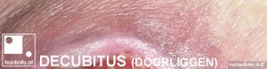 decubitus doorliggen