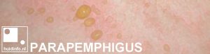 parapemphigus bulleus pemphigoid parapemfigus