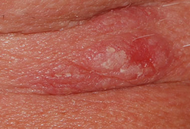 pemphigus pemfigus