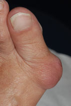 bunion hallux valgus