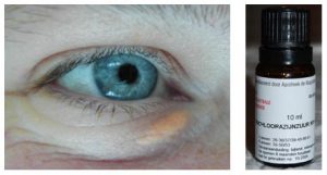 xanthelasma palpebrarum boterbril