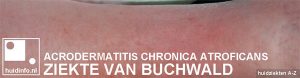 acrodermatitis chronica atroficans ziekte van Buchwald