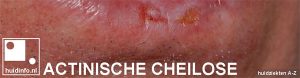 actinische cheilose actinische cheilitis