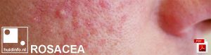 acne rosacea