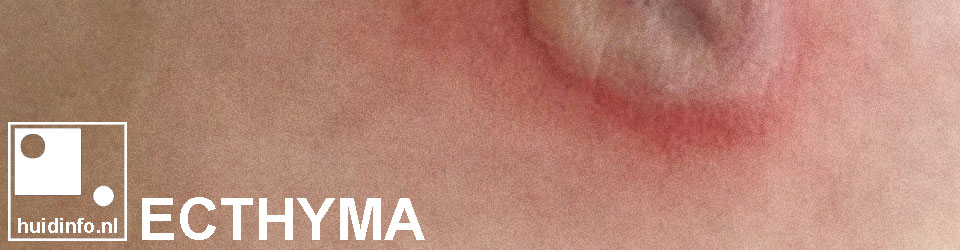 ecthyma