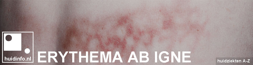 Erythema Ab Igne Info Van De Dermatoloog erythema-ab-igne-info-van-de-dermatoloog