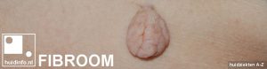 fibroom fibromen gesteeld skintag acrochordon