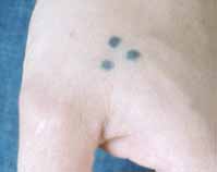 tattoo tatoeage pigment laser
