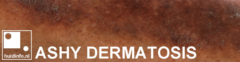 ashy dermatosis erythema dyschromicum perstans postinflammatoire hyperpigmentatie