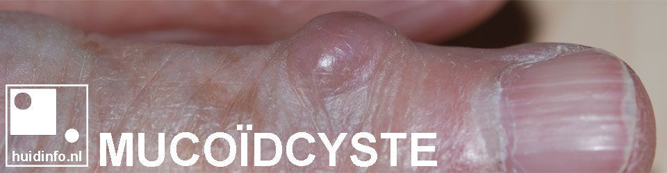 mucoïdcyste myxoïd mucus vinger teen bobbeltje