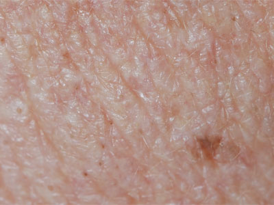 backup Investeren Bad JEUK EN DE HUID - oorzaken met FOTO's | uitleg DERMATOLOOG