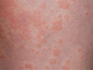 urticaria galbulten netelroos jeuk