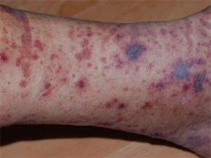 vasculitis