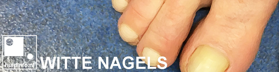 Witte nagels | huidinfo.nl -