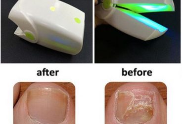 Cozing Infrared Cold Laser Nail Fungus Therapy Device Toe And Finger Nail Fungus Laser Treatment Machine