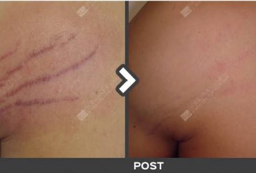 Permanent Stretch Mark Removal