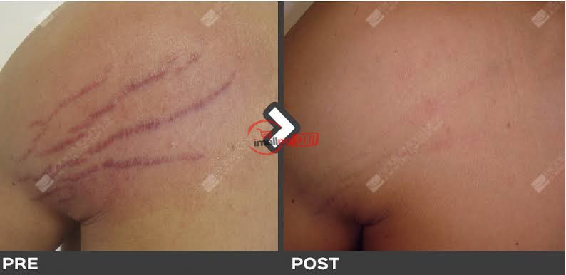 Permanent Stretch Mark Removal