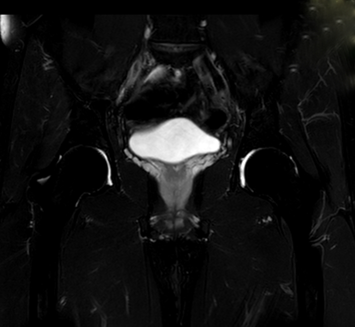 Becken MRT | Impingement Hüfte