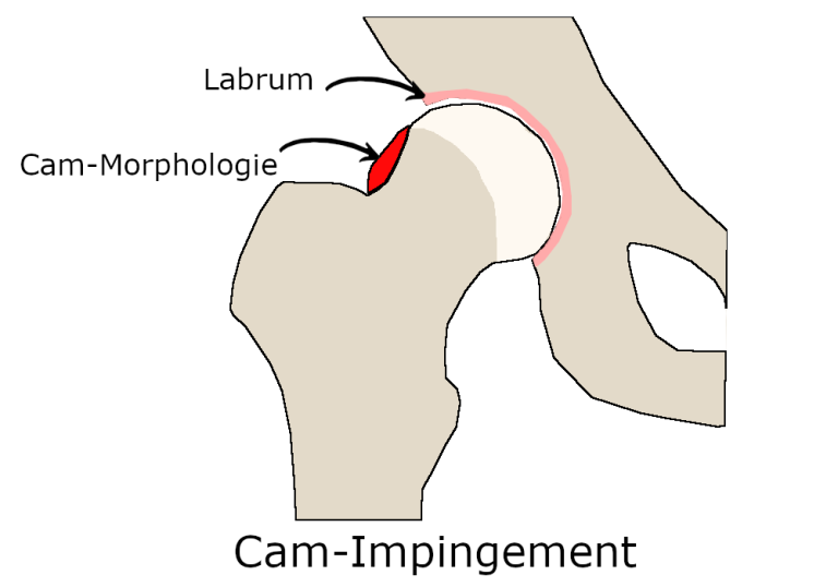 Was ist ein primäres CamImpingement? Impingement Hüfte