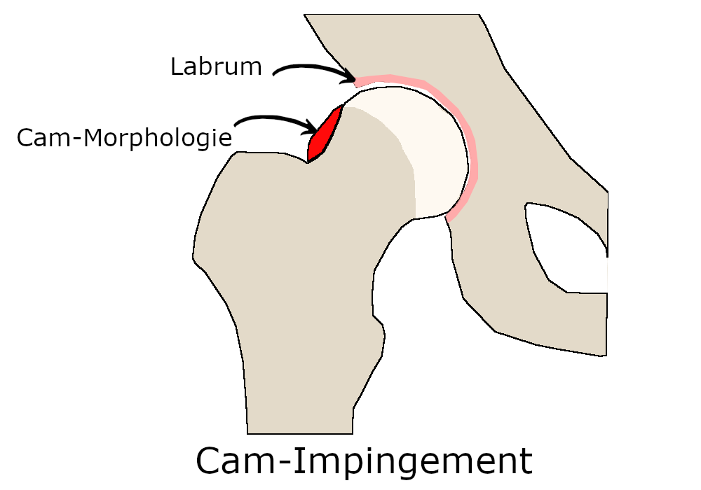 Die rot markierte Stelle zeigt die klassische Cam-Morphologie. Eine Kugelform des Oberschenkelkopfes ist nicht mehr gegeben.