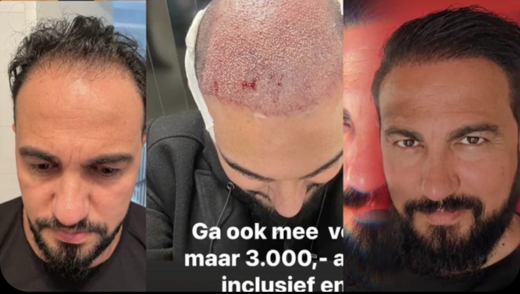 Haartransplantatie