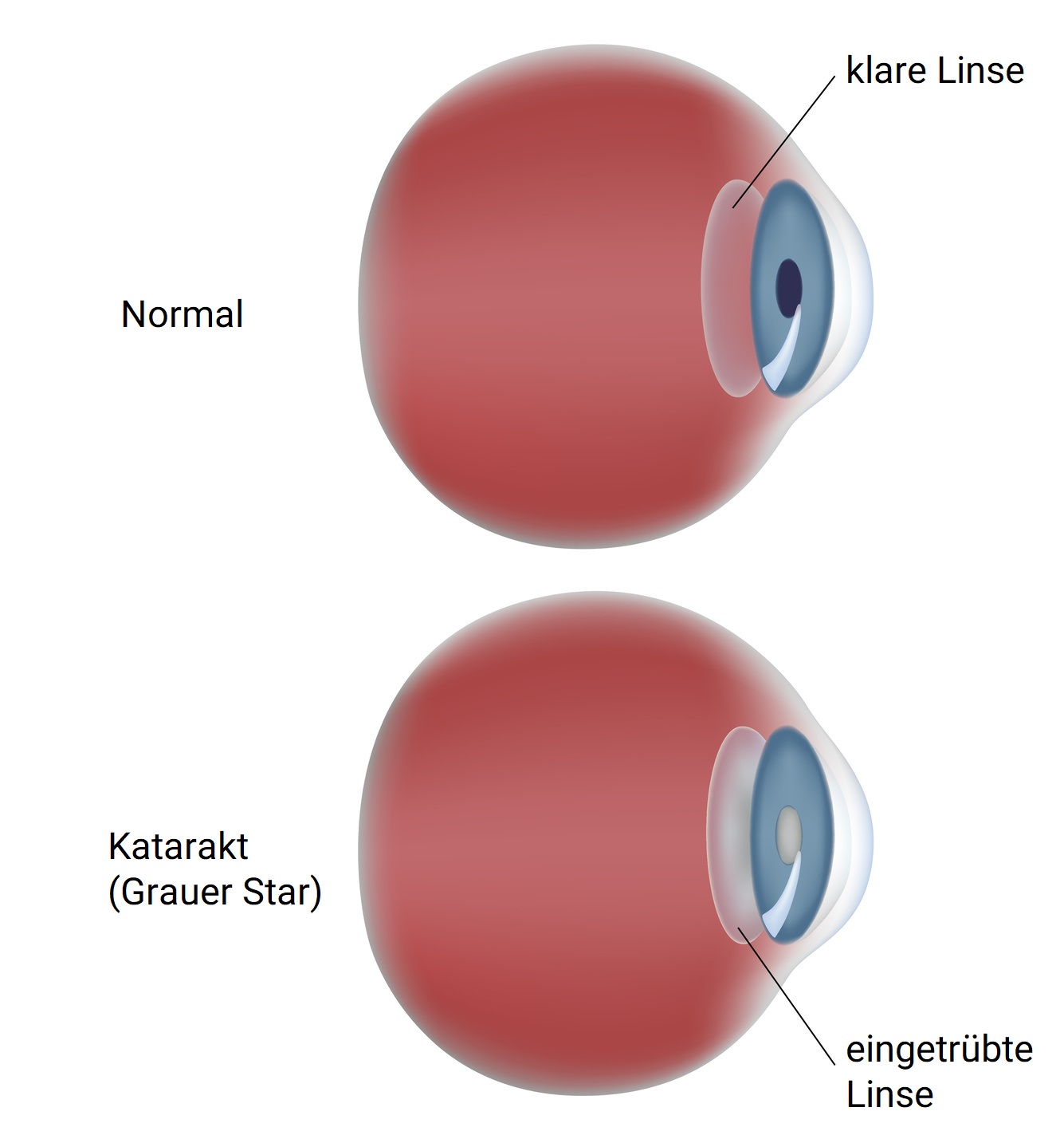 Grauer Star: Ursachen, Operationsmöglichkeit und passende Linsen für die  Augenkrankheit im Alter
