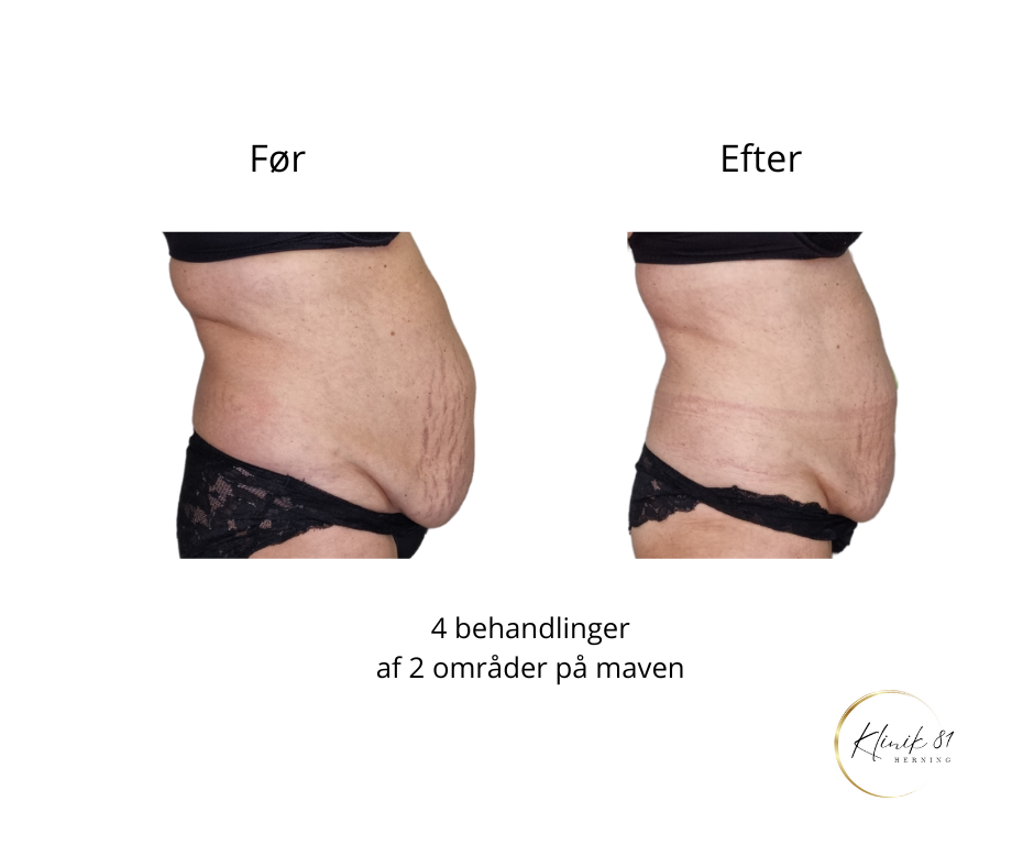 Fedtsugning mave, Fedtreduktion mave, hudopstramning mave, Onda Coolwaves, Prisvindende behandlinger med dokumenteret effekt, Klinik 81, fedtfrysning, fedtfrysning mave,