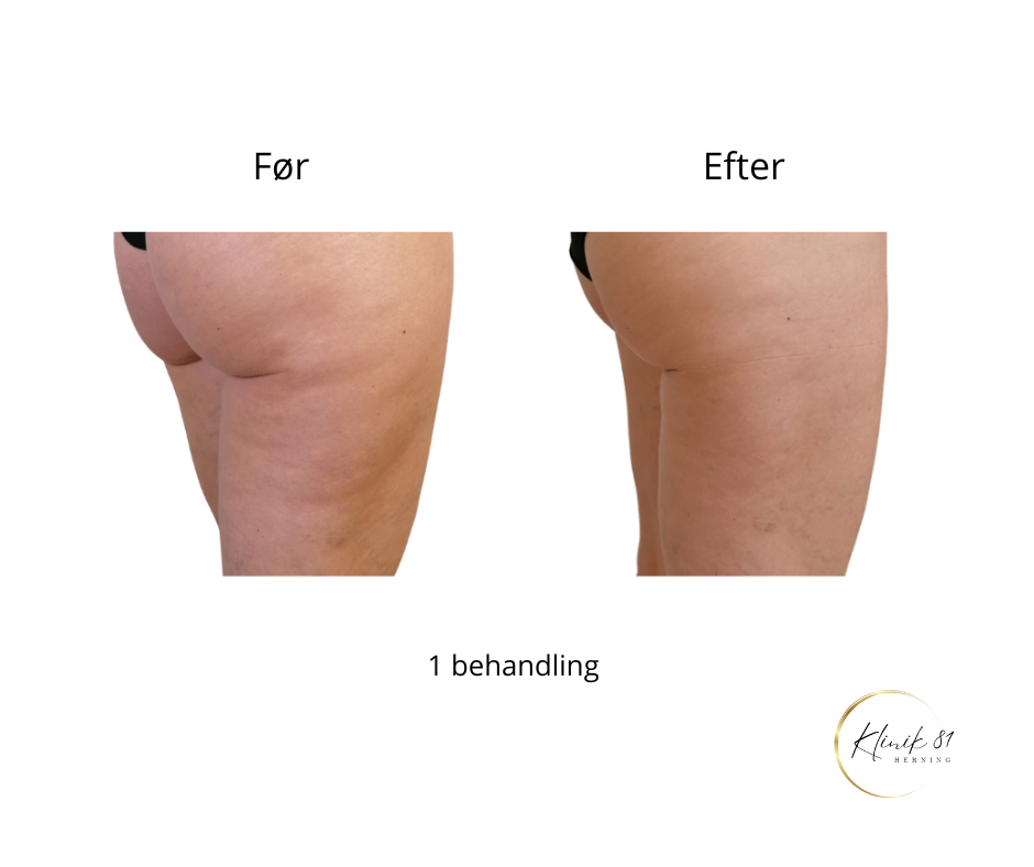 Opstramning lår, fedtsugning lår, fedtsugning knæ, fedtreduktion lår, reduktion af cellulite, reduktion af appelsinhud,, fedtfrysning lår, fedtfrysning knæ, fedtreduktion knæ, Klinik 81, 