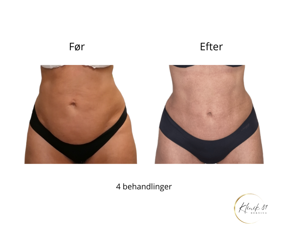 Onda Coolwaves
Fedtreduktion
Hudopstramning
Reduktion af cellulite
Prisvindende behandlinger med dokumenteret effekt - uden kirurgi.
Klinik 81