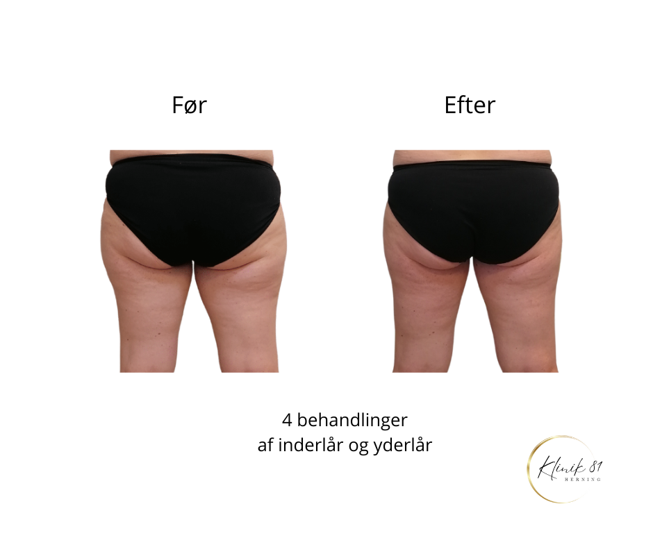 Opstramning lår, fedtsugning lår, fedtsugning knæ, fedtreduktion lår, reduktion af cellulite, reduktion af appelsinhud,, fedtfrysning lår, fedtfrysning knæ, fedtreduktion knæ, Klinik 81, 